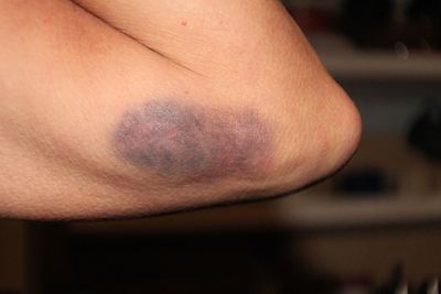 keystone xl bruise